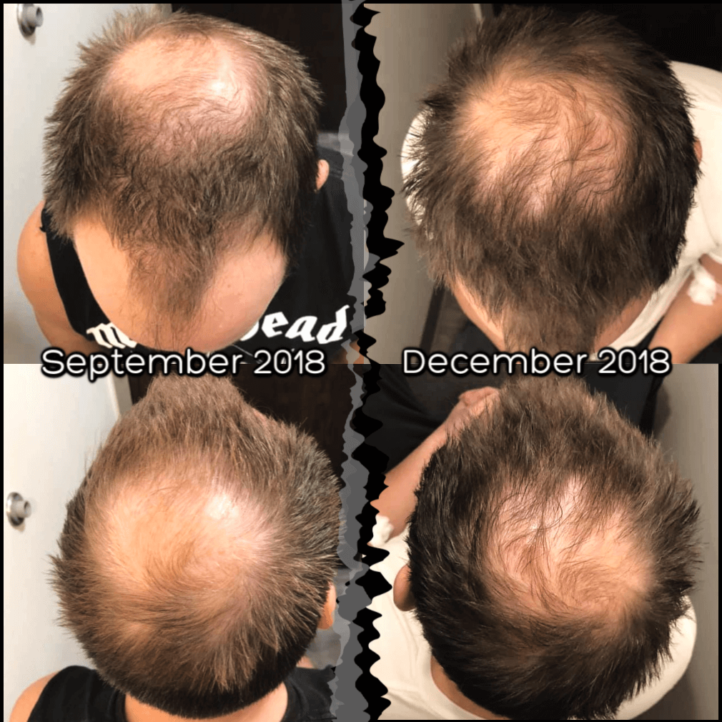 PRP for Hair Loss Treatment Options What is PRP for Hair Loss Treatment   Forefront Dermatology